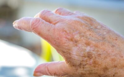 Do You Know the ABCDE’s of Melanoma in Seniors?